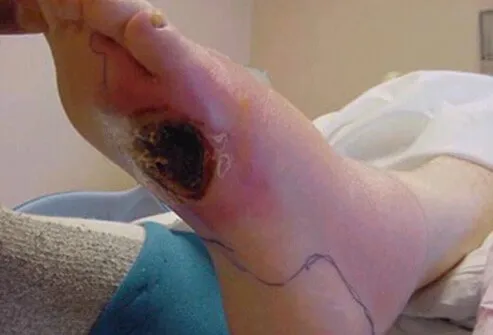 diabetes_foot_problems_s12_ulcers.jpg