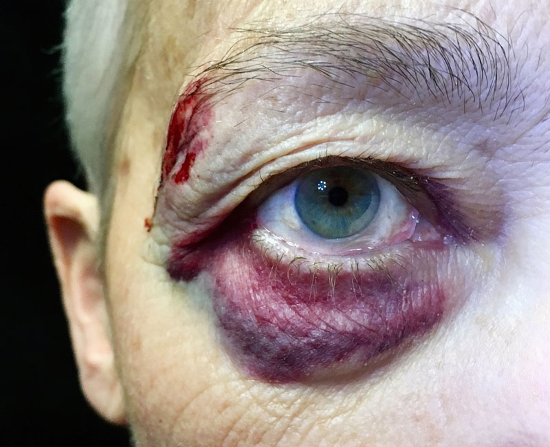 black-eye.jpg