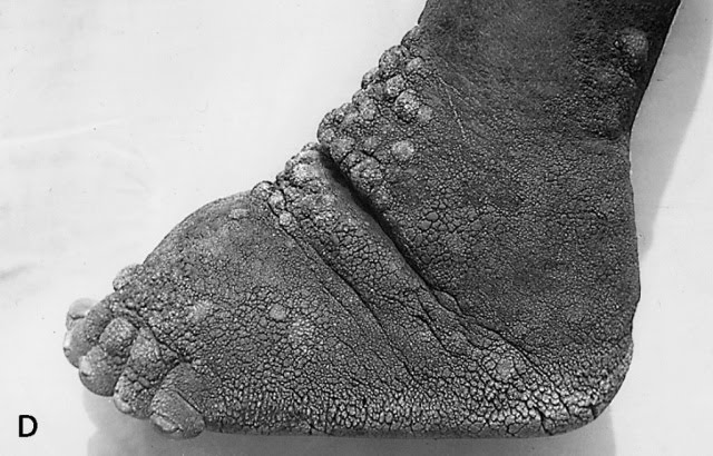 podoconiasis.jpg