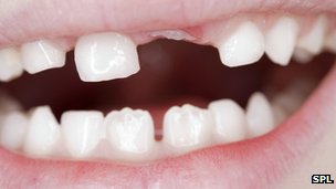 _69009962_c0166230-loss_of_milk_teeth-spl.jpg